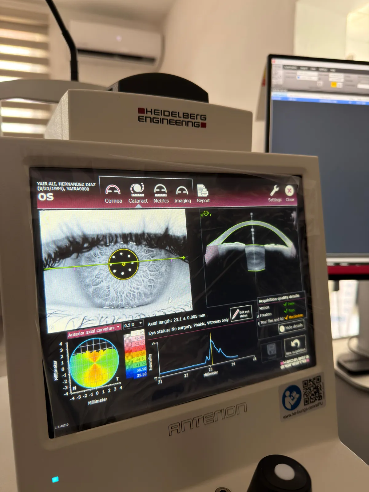 Biometría ocular Anterion para cirugía de cataratas