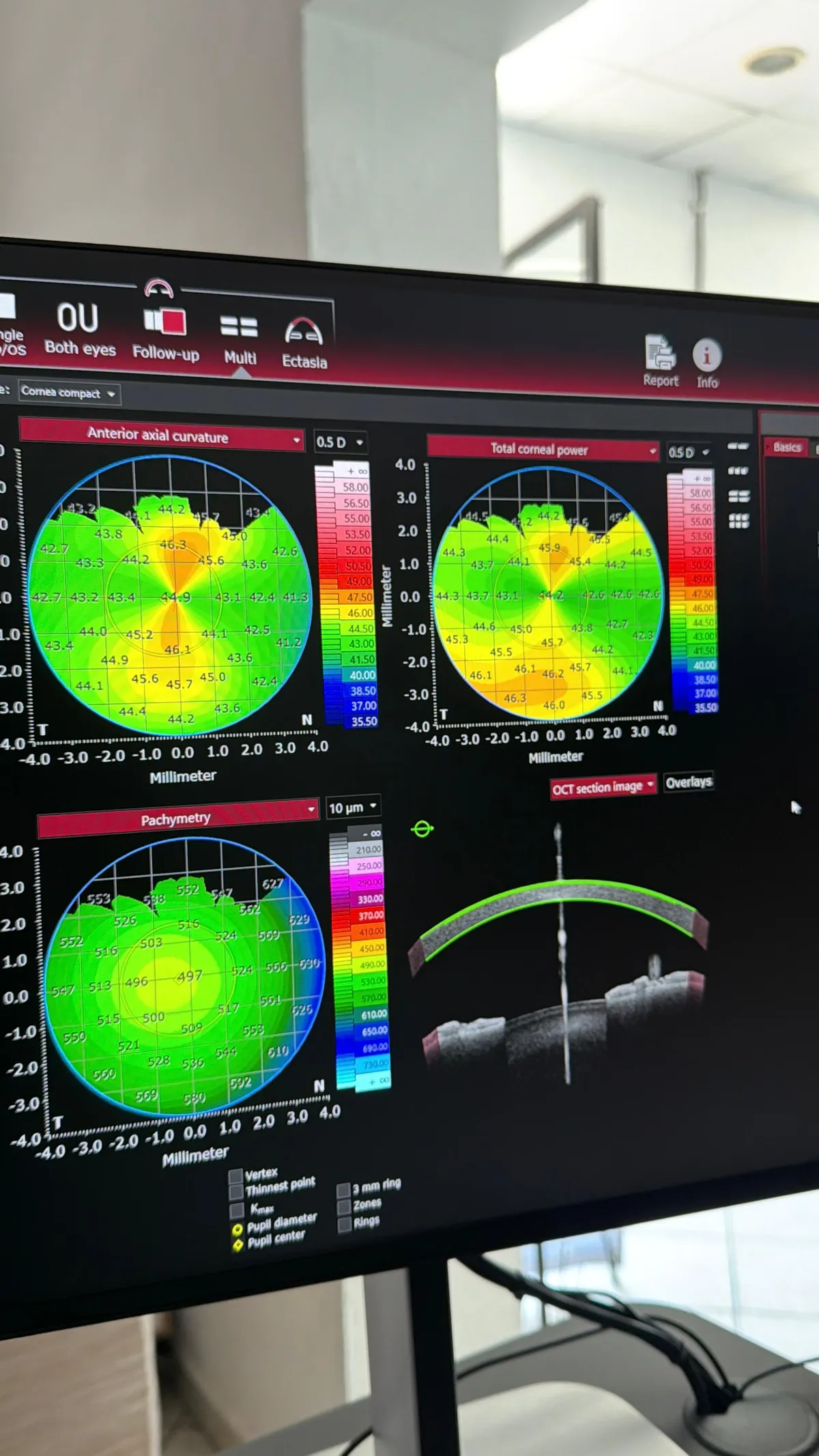 Topografía corneal con paquimetría